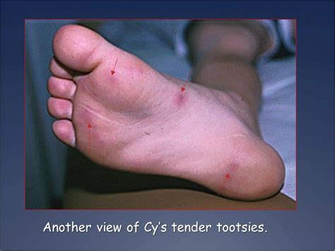 Sudden Painful Bumps On The Feet Of A Child Patient Care Online