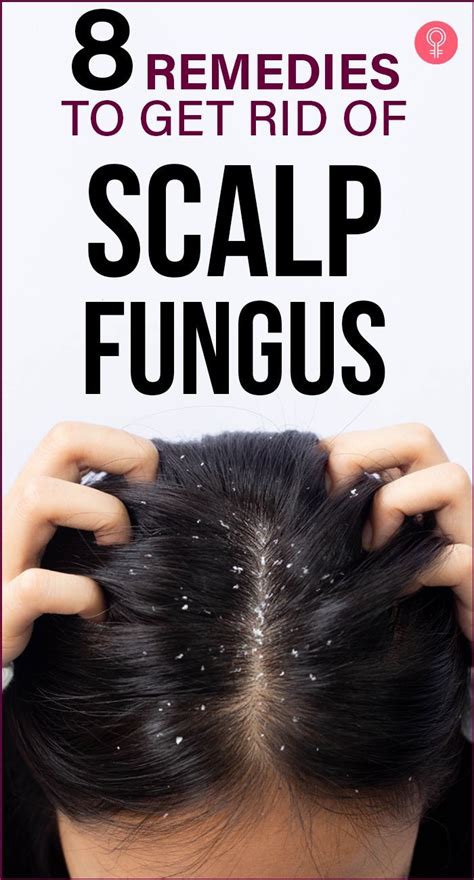 8 Home Remedies To Get Rid Of Scalp Fungus Prevention Tips Artofit
