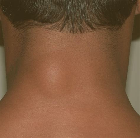 Lump On The Back Of Head