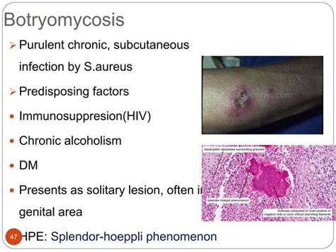 Staphylococcal And Streptococcal Skin Infections Ppt