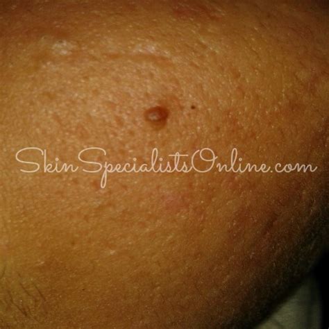 Ask A Skin Doctor Dermatosis Papulosa Nigra Skin Specialists Online