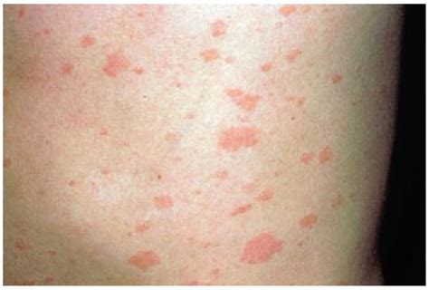 Ehrlichiosis A Child With A Maculopapular Rash On His Trunk