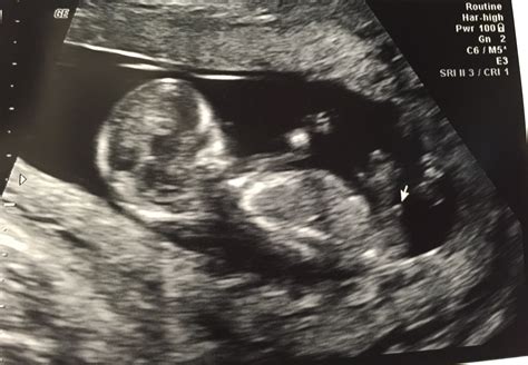 12 Week Ultrasound Tech Gave Definite Boy Answer — The Bump