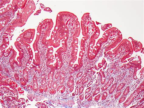 Celiac Disease Patients with Ongoing Intestine Damage at Lymphoma Risk ...