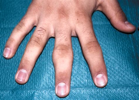 Finger Joint Swellings In A Teenager Juvenile Rheumatoid