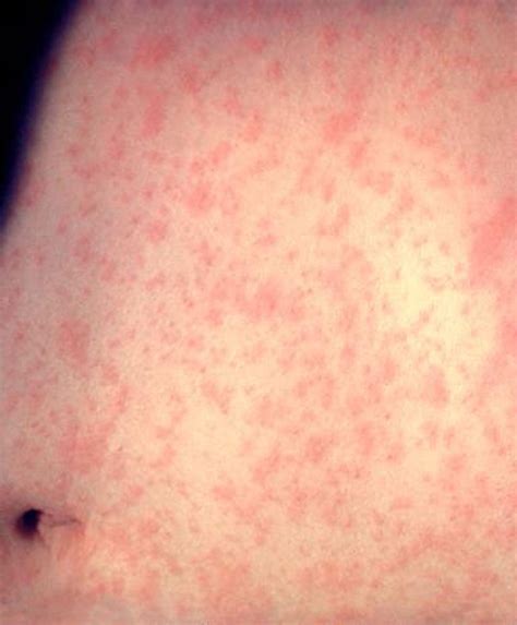 Measles In The Us What To Know About Outbreaks Vaccines And More