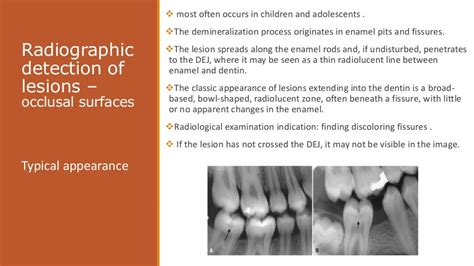 Dental Caries Radiographic Interpretation Of Dental Caries