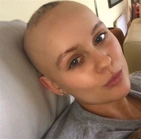 Hair Doesnt Define Beauty Says This Woman Who Has Alopecia Metro News