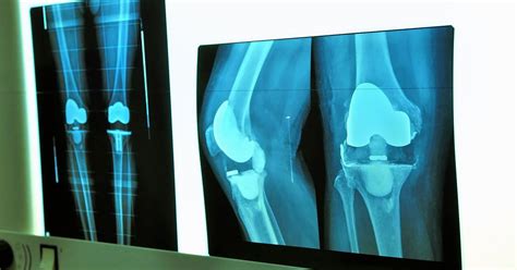Do X Rays Show Knee Damage Whadoq