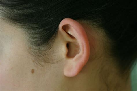 Sticking Out Ears And Lobes No Surgery And Surgery Options For All Ages