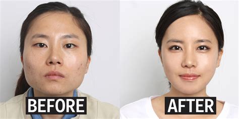 Eyelid Surgery In South Korea