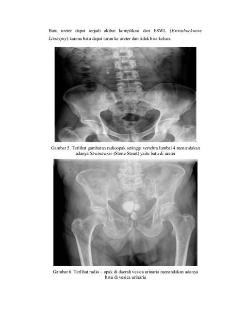 Radiology Pada Urolithiasis