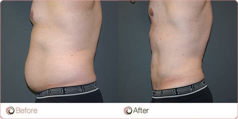 Male Tummy Liposuction View Before And After Photos