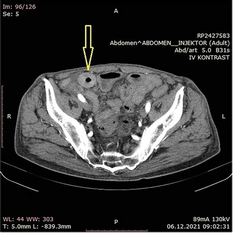 Abdominal Ct Scan Showing Small Bowel Wall Thickening Described As
