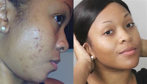How To Remove Black Skin Care Products For Dark Spots Naturally Skin