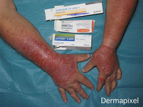 Dermatitis De Contacto Fotos Storycog