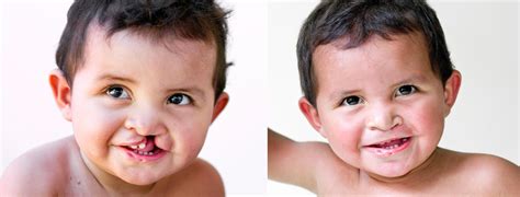 Daniel From Brazil Before And After Cleft Lip Surgery