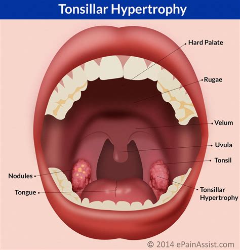 Tonsillar Hypertrophy Score