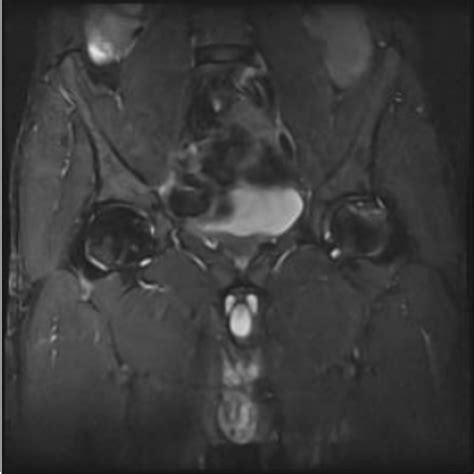 Bilateral Avascular Necrosis Avn Of Both Femoral Heads With