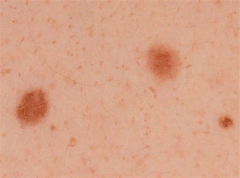 melanoma pictures by stages stage 0 1 2 3 4 melanoma pictures melanoma in situ picture