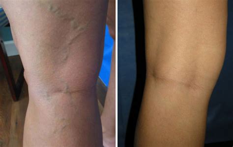 The Cause And Treatment Of Blue Veins In Jacksonville