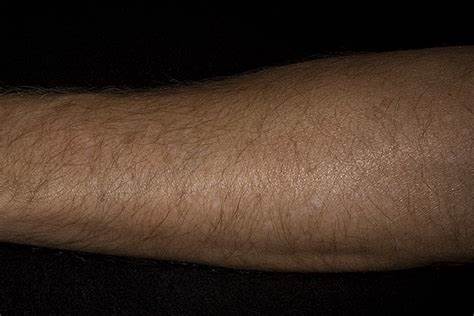 Экзема истинная диета Идиопатическая экзема: Истинная экзема - причины, симптомы, диагностика Идиопатическая экзема: Истинная экзема - причины, симптомы, диагностика Экзема истинная диета