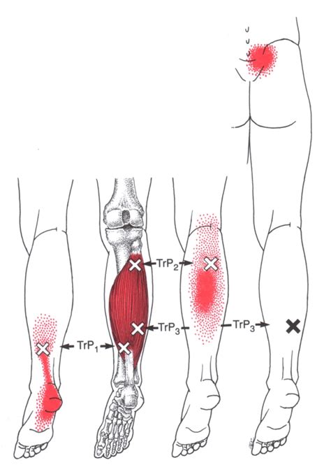 Soleus The Trigger Point And Referred Pain Guide