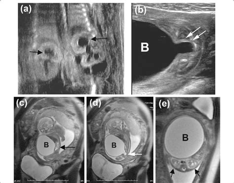 Prenatal Ultrasound A B And Fetal Mri C D E Showing Bilateral