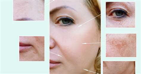 4 Common Skin Pigmentation Causes And Treatments You Have To Know