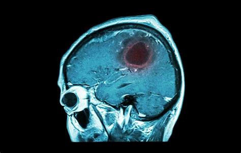 7 Warning Signs Of A Brain Tumor You Should Know