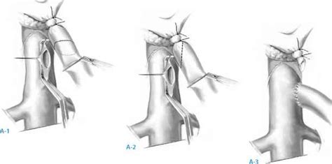 Multiple Steps In Sewing An Endtoside Portacaval Anastomosis Hepatic