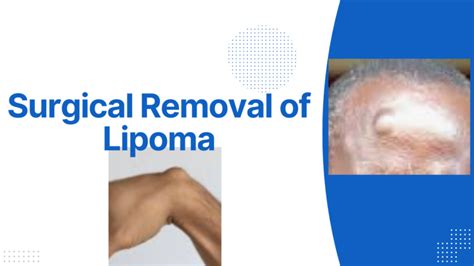 Lipoma Removal Surgery What You Need To Know