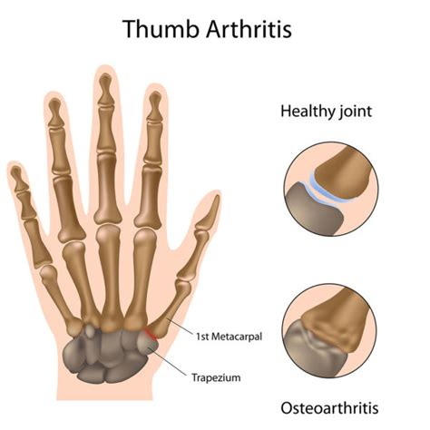 Osteoarthritis Of The Thumb 1st Cmc Thumb Ultrasound Guided Injections