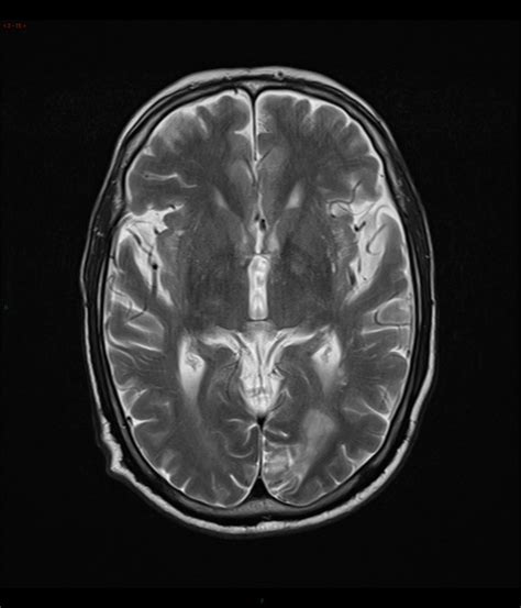 Left Posterior Cerebral Artery Territory Infarct Image