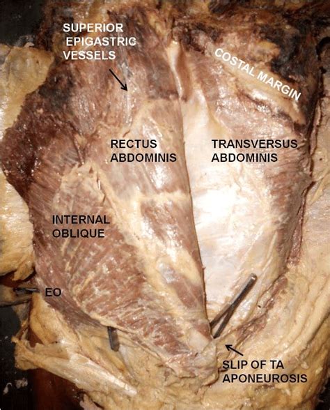 Ventral View Of The Abdominal Wall The Posterior Wall Of Rectus Sheath
