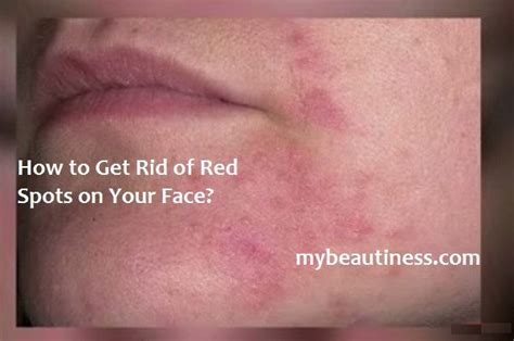 Best 25 Red Spots On Face Ideas On Pinterest Pimple Mask Spots On