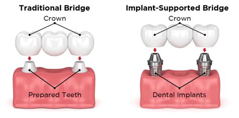Implant Crowns And Bridges Dr Brant Arnold
