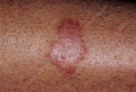 Ringworm Stock Image M2700262 Science Photo Library
