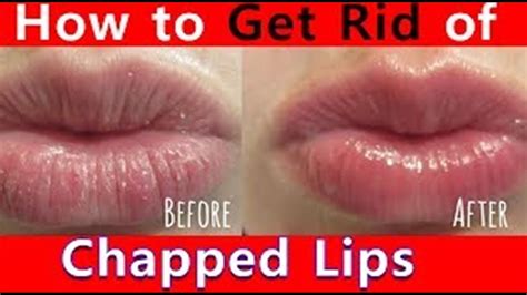 How To Cure Dry Lips Remedies For Curing Dry And Chapped Lips Youtube
