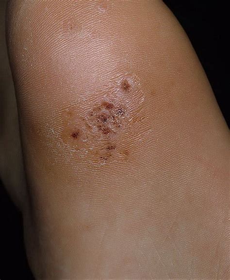 Common warts tend to cause no discomfort unless they are in areas of repeated friction or pressure. Plantar Wart Pictures - 20 Photos & Images / illnessee.com