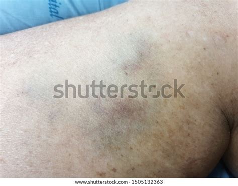 Skin Disease Lesion Ecchymosis Vasculitis 스톡 사진 1505132363 Shutterstock