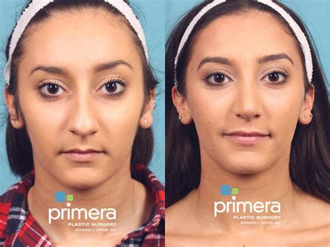 Rhinoplasty Before And After Pictures Case 559 Orlando Florida
