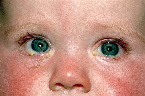 What Do You See A Refresher On Diagnosing Conjunctivitis Advances In