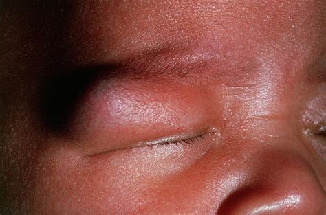 Dermoid Cyst On An Infants Eyelid Photograph By Science Photo Library
