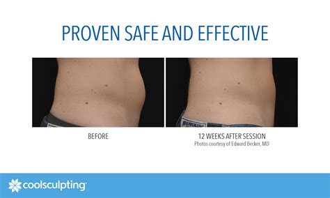 Coolsculpting Fat Freezing In West London The Hogarth Medispa