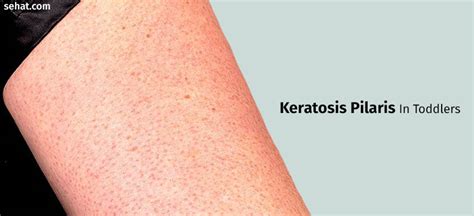 Keratosis Pilaris Treatment For Kids Captions Trend