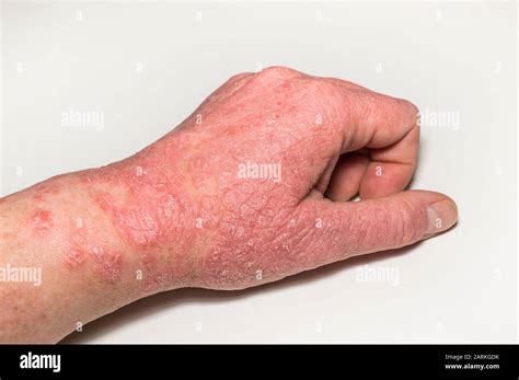 Lésions Cutanées Allergiques De La Main Avec Fissures Inflammation Et