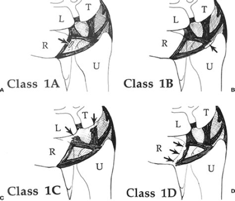 Arthroscopic Repair Of The Triangular Fibrocartilage Complex Tfcc
