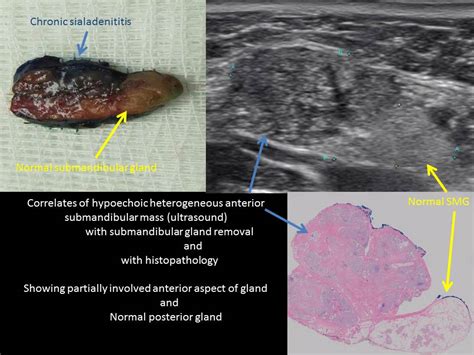Chronic Submandibular Gland Sialadenitis Case Example Iowa Head And