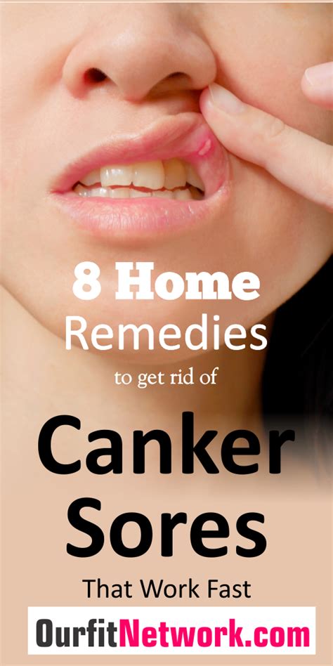 8 Home Remedies To Get Rid Of Canker Sores That Work Fast In 2021